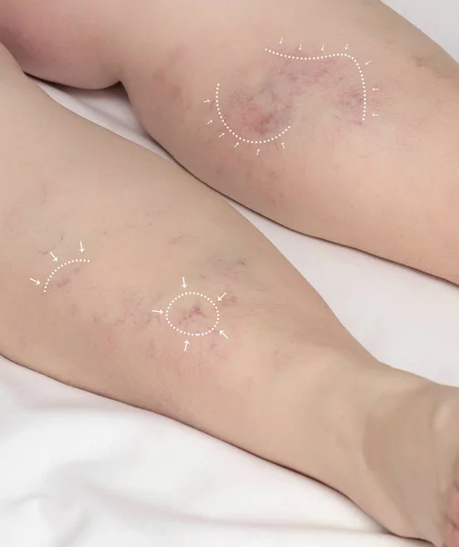 Markörer på benen på en kvinna före operation för att behandla och ta bort benvener. Begreppet behandling av åderbråck och tromboflebit, flebologi och flebectomi — Stockfoto