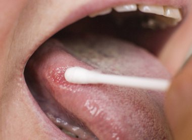 Bir kadının dilindeki hastalık için leke sürüyor. Glossitis ve diş eti iltihabı dil hastalığı araştırma konsepti, tıbbi