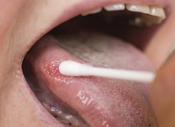 Bir kadının dilindeki hastalık için leke sürüyor. Glossitis ve diş eti iltihabı dil hastalığı araştırma konsepti, tıbbi — Stok fotoğraf