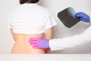 An orthopedic doctor examines a patient using an x-ray for a fracture of the back ribs. Concept of bruised and damaged ribs on the back, background
