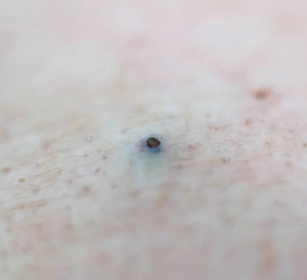 Black pimple acne on human skin, background. Acne and acne treatment, cosmetology, hygiene — 스톡 사진