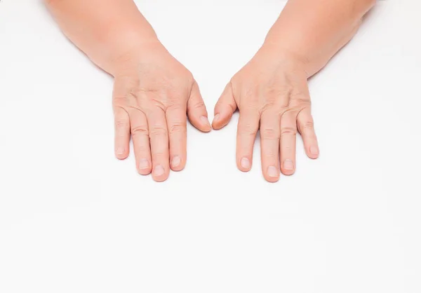 Peau Sèche Avec Rides Sur Les Mains Une Femme Âgée — Photo