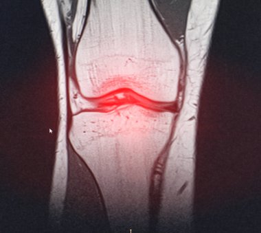 A snapshot of the diagnosis of an MRI of the knee in which arthrosis and arthritis. The concept of joint diagnosis using x-rays, treatment of diseases of the knee joint, bursitis, periarticular bag clipart