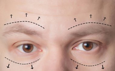 Plastic surgery of eyebrows in men, lower and upper eyelids. The concept of the modern blepharoplasty procedure, lifting clipart