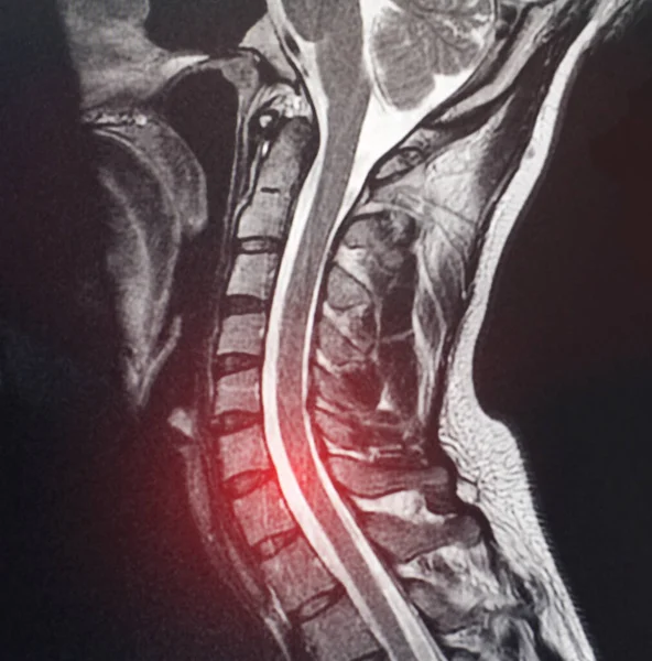 Magnetic Resonance Image Cervical Spine Patient Who Has Pain Numbness — Stock Photo, Image