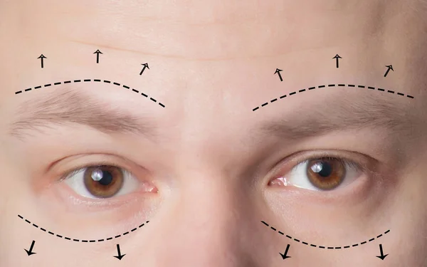 Cirurgia Plástica Sobrancelhas Homens Pálpebras Inferiores Superiores Conceito Procedimento Blefaroplastia — Fotografia de Stock