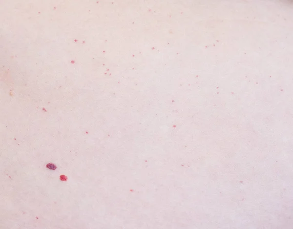 Zwei Rote Muttermale Auf Der Haut Des Patienten Hämangiom Angioneuromen — Stockfoto