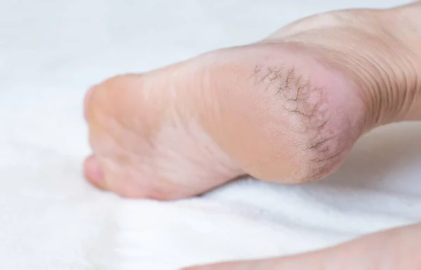 人の足のかかとに乾燥割れ皮膚 クローズアップ 皮膚や甲状腺の重篤な疾患の概念 — ストック写真