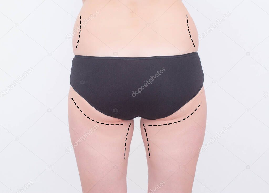 Marks on the legs and buttocks of a girl on a white background. The concept of buttock augmentation and shaping in cosmetology with implants, implant plastic