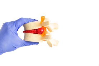Doktor nörolog omurgasında omurgalar arası fıtık olduğunu söylüyor. Omurga hastalığı konsepti ve tecrit edilmiş ya da orta fıtık, izole edilmiş..