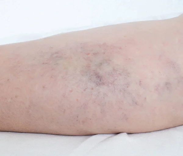 Varicose veins on the legs of a person, thrombophlebitis, anatomical — Stock Photo, Image