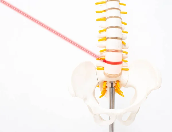 Mock up human spine on a white background with a laser. The concept of a new modern method without surgery for the treatment and removal of intervertebral hernias, copy space — Stock Photo, Image