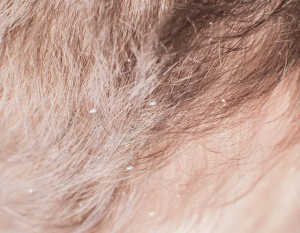 Łupież Brązowych Włosach Ludzi Koncepcja Pozbycia Się Łupieżu Pielęgnacji Włosów — Zdjęcie stockowe