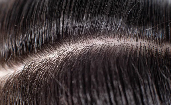 Łupież Czarnych Włosach Mężczyzny Koncepcja Pozbycia Się Łupieżu Pielęgnacji Włosów — Zdjęcie stockowe