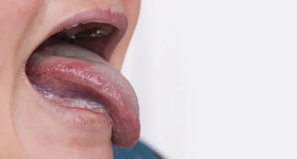 Vrouw Met Een Ziekte Roodheid Van Tong Glossitis Gingivitis Ziekte — Stockfoto