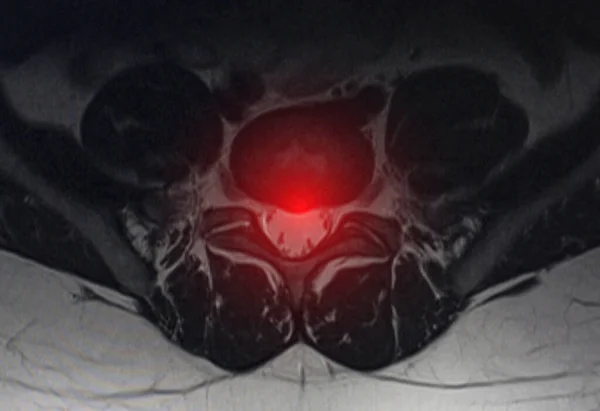 Image after examination of magnetic resonance imaging. Spine examination concept, degenerative changes in the intervertebral discs, spondylarthrosis — Stock Image Image Examination Magnetic Resonance Imaging Spine Examination Concept Degenerative Changes Stock Picture