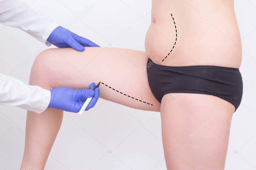 Doctor plastic surgeon makes a marker marker for a modern operation to remove subcutaneous fat from the hips and abdomen of a girl. Sociology of Plastic Surgery, Abdominoplasty and Laser Lipolysis