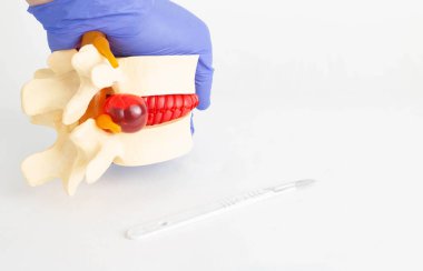 Yanında cerrahi neşter bulunan omurgalar arası fıtığı olan bir omurga modeli. Omurga fıtığı, laminektomi ve mikrodisektomi için modern cerrahi operasyonlar konsepti.