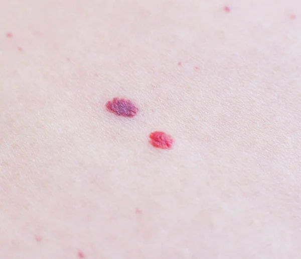 Dois moles vermelhos na pele do paciente, hemangioma, macro, angioneuromas — Fotografia de Stock