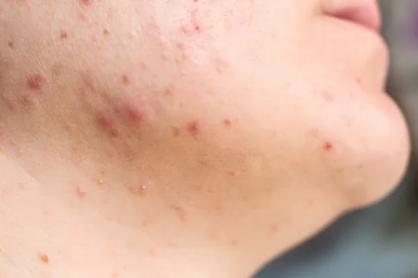 Acne vermelha e uma erupção na cara e pescoço das meninas, macro, hormônio — Fotografia de Stock