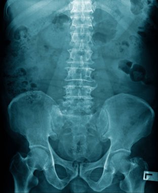 lumbar spondiloz x-ray görüntüsü 