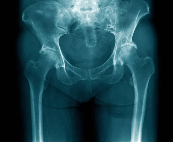 Imagen de rayos X hueso pélvico — Foto de Stock