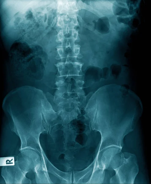 Lumbar spondylosis x-ray image — ストック写真