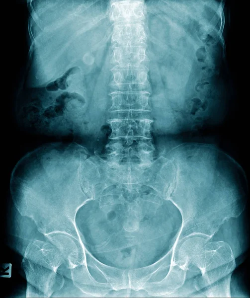 Radiografia da coluna vertebral humana e espondilose lombar — Fotografia de Stock