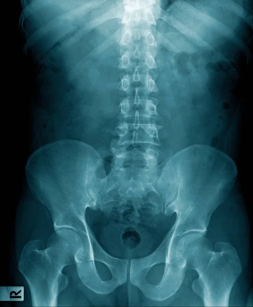 İnsan omurgasının röntgen görüntüsü ve bel spondilozu. — Stok fotoğraf