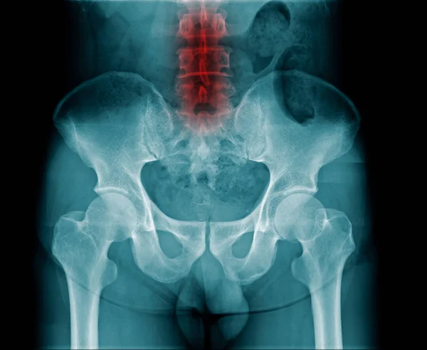 Imagen de rayos X del hueso pélvico y parte de la columna lumbar — Foto de Stock