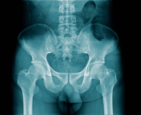 Imagen de rayos X del hueso pélvico — Foto de Stock