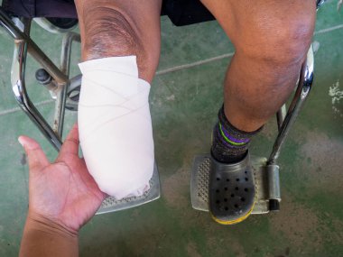 Elastik bandajlı kask ampütasyonu 