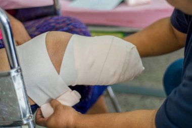 diabetes mellitus Bk amputasyonunda elastik bandaj