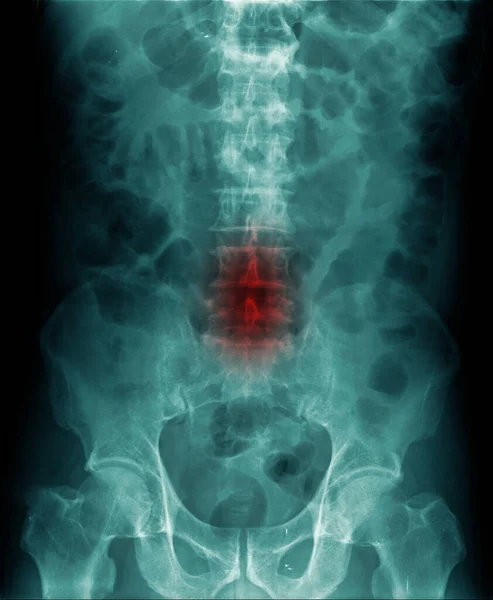 Radiografía Abdominal Muestra Espondilosis Lumbar Cambio Degenerativo — Foto de Stock