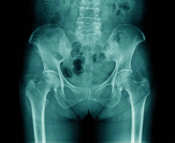 Imagem Radiológica Mulher Idosa Osso Pélvico Raios Parte Osso Lombar — Fotografia de Stock