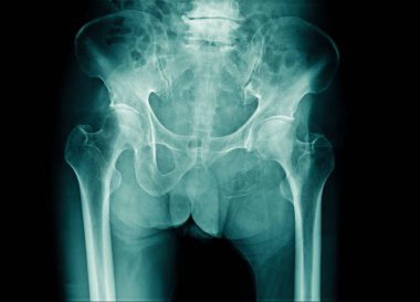 X-ray görüntü leğen kemiği ve omurga ya da dejeneratif değişim ile I-omurganın bir parçası