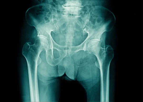 x-ray image pelvic bone and part of l-spine with compression of spine or degenertive change