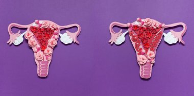 Kadınların üreme sistemi işte. Rahmin endometriyozis konsepti. 