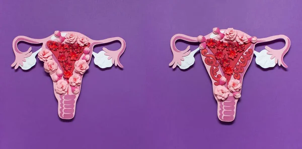 The womens reproductive system. The concept of endometriosis of the uterus. Royalty Free Stock Photos