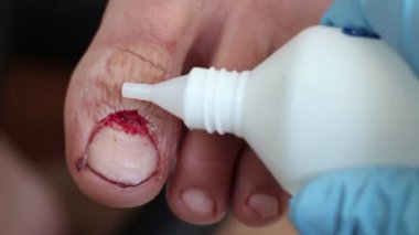 Cerrahi tırnak hastalıkları için. Ayak tirnagi kaldırma ameliyatı