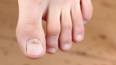 Tırnak mantar. Yeni sağlıklı çivi ile eski mantar çivi çivi üst olduğunu