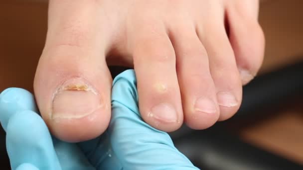 两根钉子长出来了 指甲手术指甲在两个褶皱内产生 形成水平劈裂的钉子 — 图库视频影像