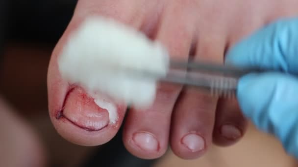 Chirurgische Eingriffe Bei Nagelerkrankungen Behandlung Und Management Der Nagelchirurgie — Stockvideo