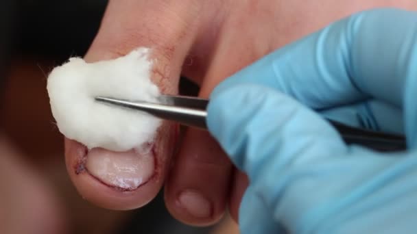 Intraoperativer Zeh Während Des Eingriffs Chirurgische Eingriffe Bei Nagelerkrankungen — Stockvideo