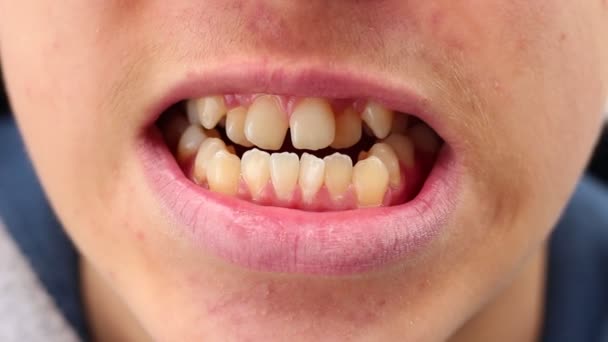 曲がった および突出の歯 不正咬合が起こるとき不一致歯と顎を引き起こす悪いかみ傷を持っている人 — ストック動画