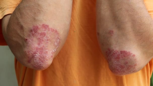 Psoriasis Elbows Psoriasis Noncontagious Chronic Skin Condition Produces Plaques Thickened — Stock Video