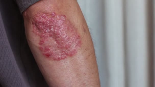 Psoriasis Red Itchy Scaly Patches Skin Plaques Red Skin Often — Stock Video