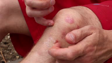 Plak Psoriazis dirsek üzerinde. Psoriasis tedavi dayanak, steroid kremler azalma inflamasyon, kaşıntı rahatlatmak ve sedef içinde abartılmış hücrelerinin üretimini engellemek