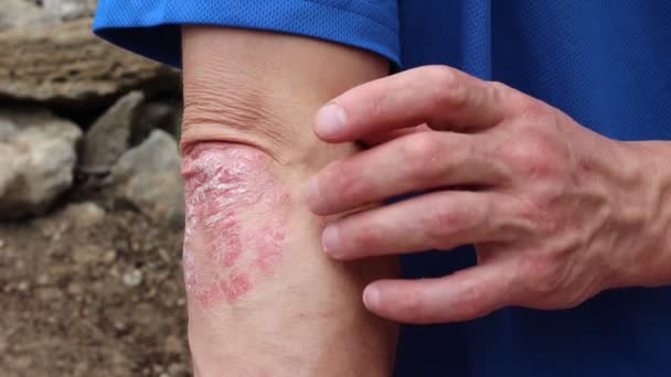 Psoriasis Est Une Affection Cutanée Chronique Non Contagieuse Qui Produit — Video