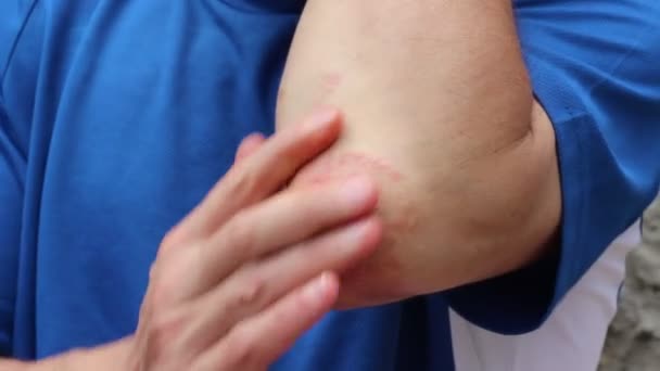 Psoriáza Noncontagious Chronické Kožní Onemocnění Které Produkuje Plaky Zamotávat Odlupující — Stock video